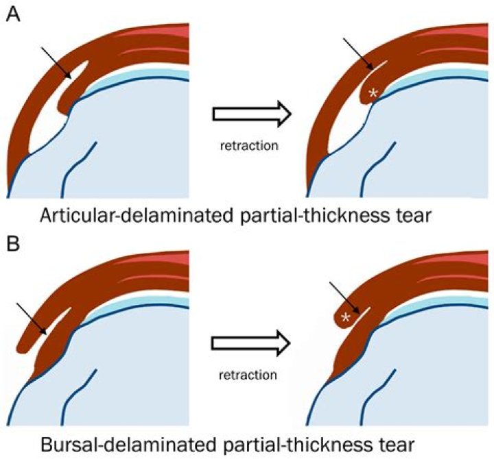 Are really pinholes signs of disc rot? + Possible delamination?