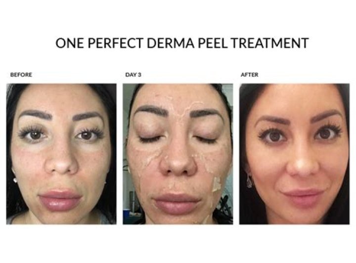 Do normal tears do increased damage with Chemical Peel?